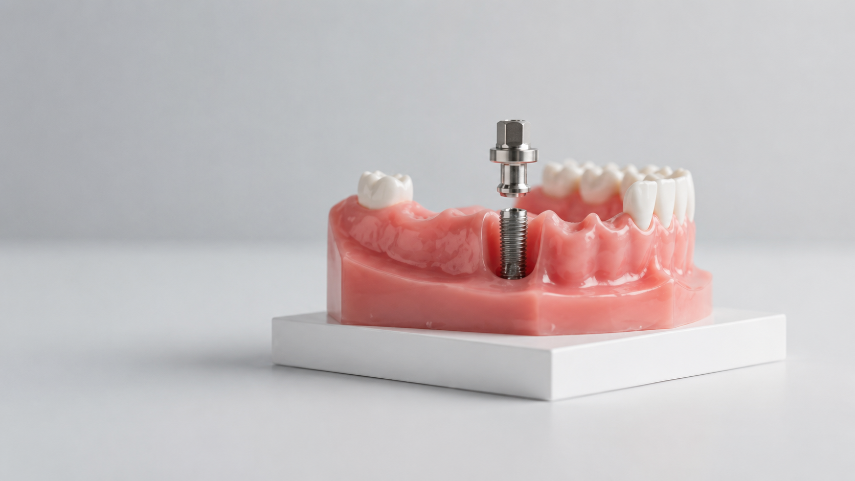 Implant Dentaire Prothese